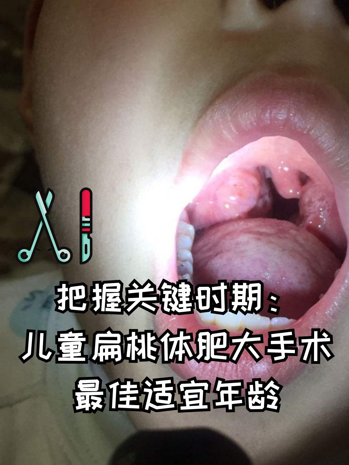 小儿扁桃体炎治疗