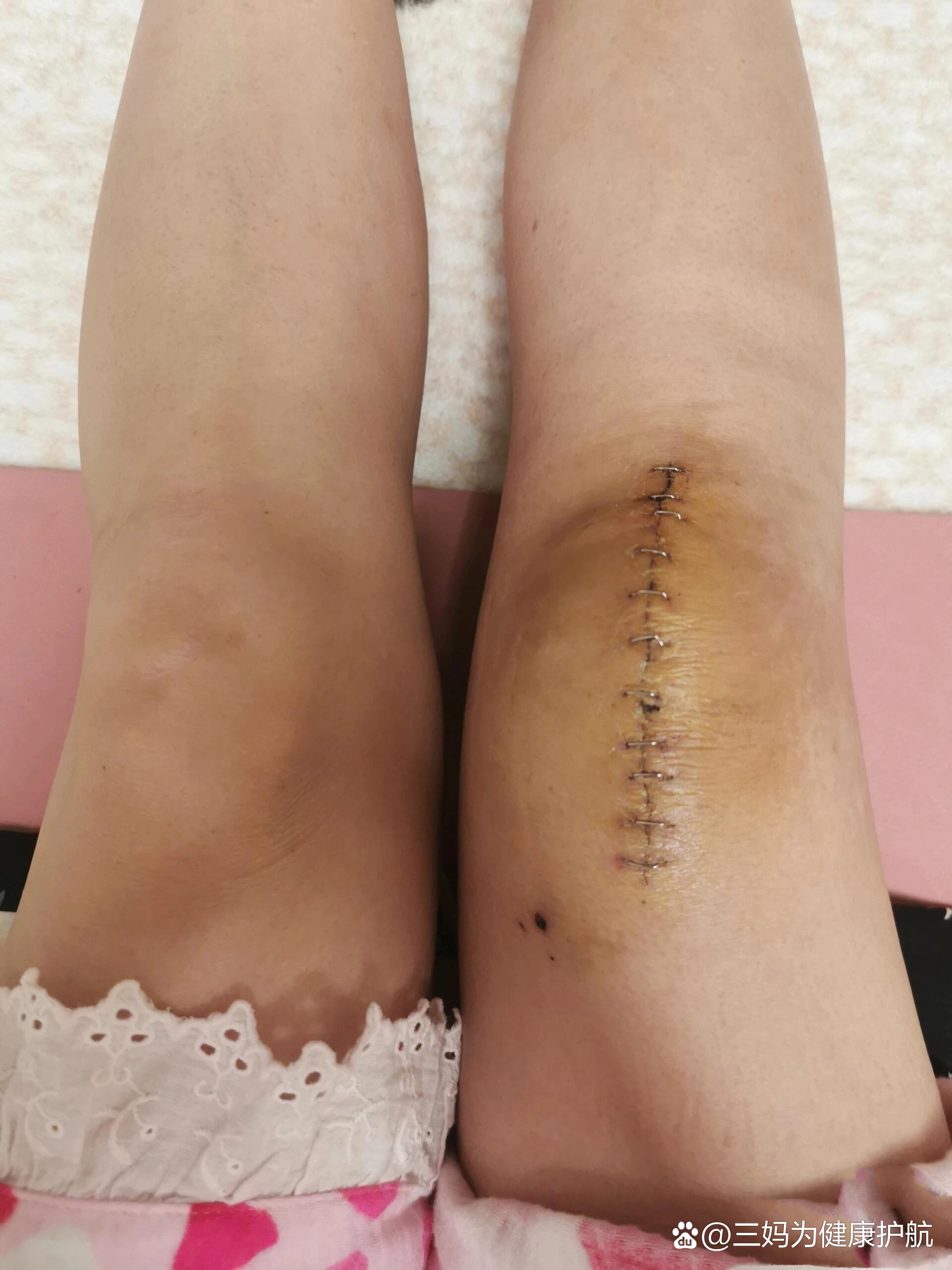 膝盖髌骨骨折多久走路