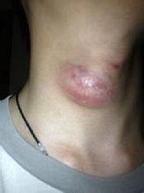 淋巴结早期都有什么症状