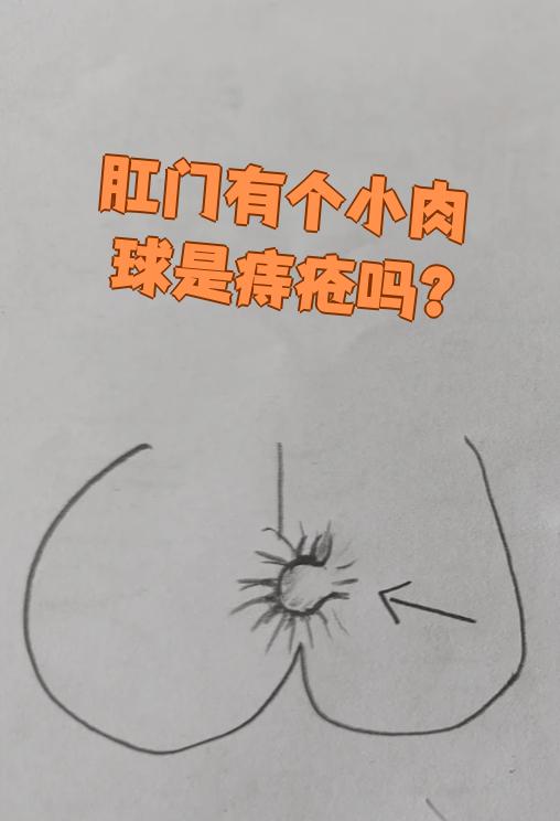 肛乳头瘤和痔疮的区别