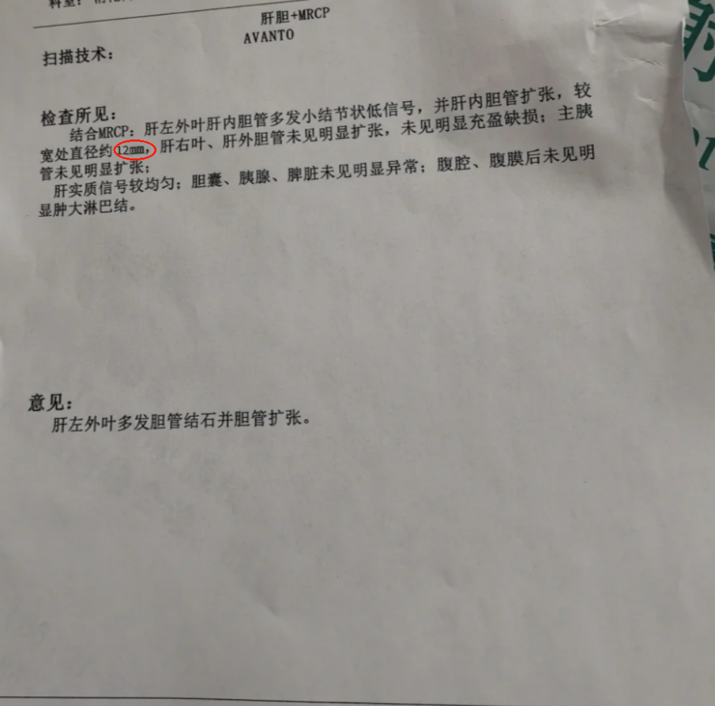 胆管扩张会有什么危害?