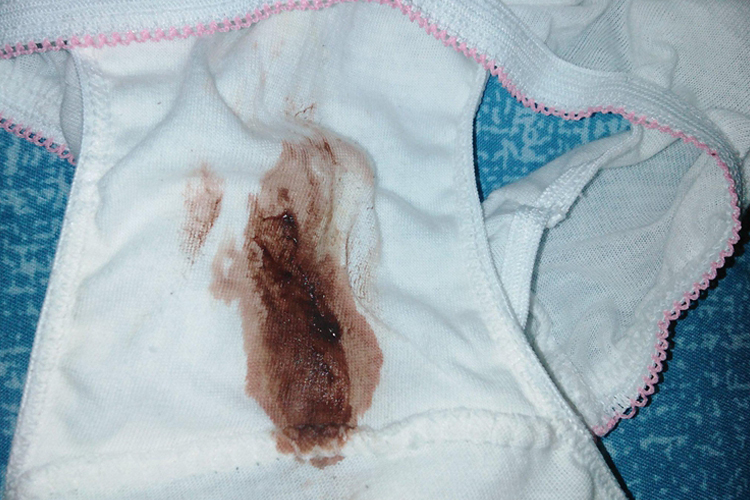 撤退性出血是什么意思?