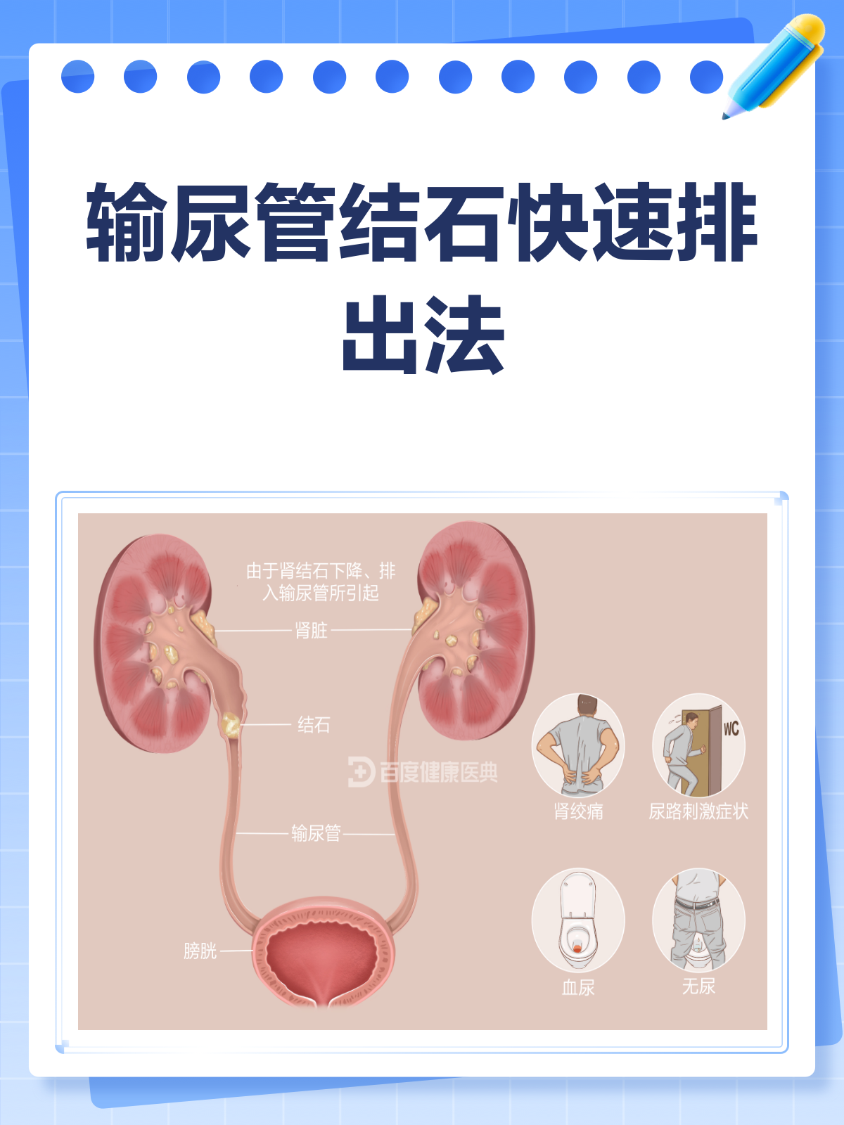 输尿管结石是什么原因引起的