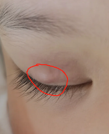 下眼皮肿了一个包还疼怎么办