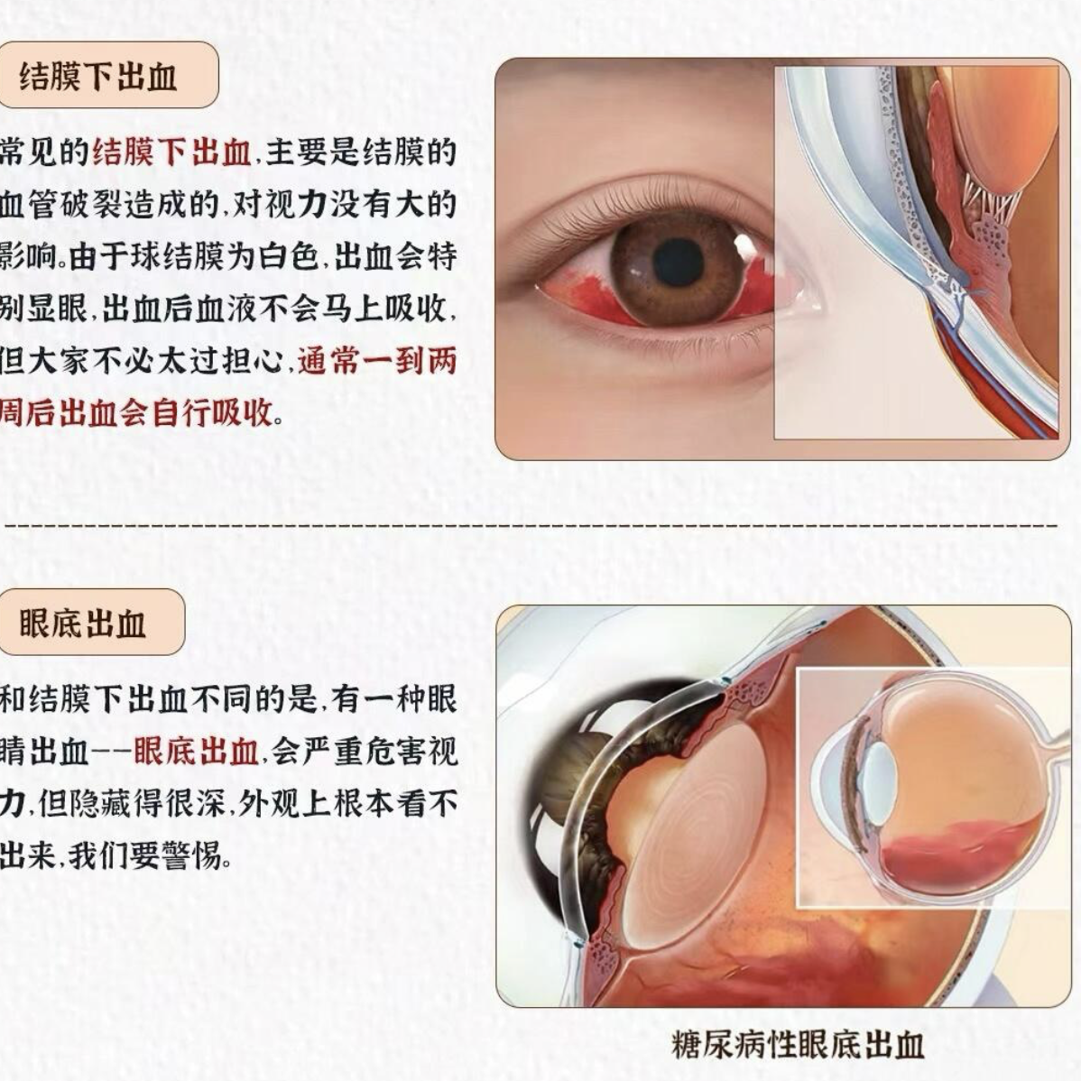 眼睛毛细血管出血怎么办