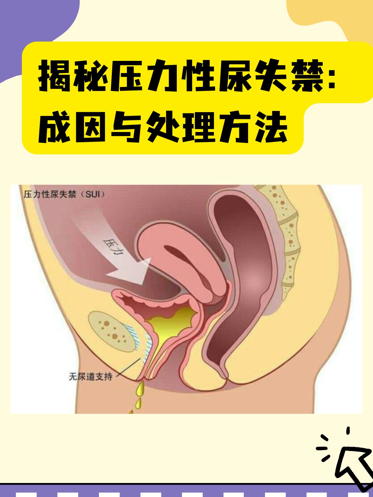 女人尿失禁治疗方法