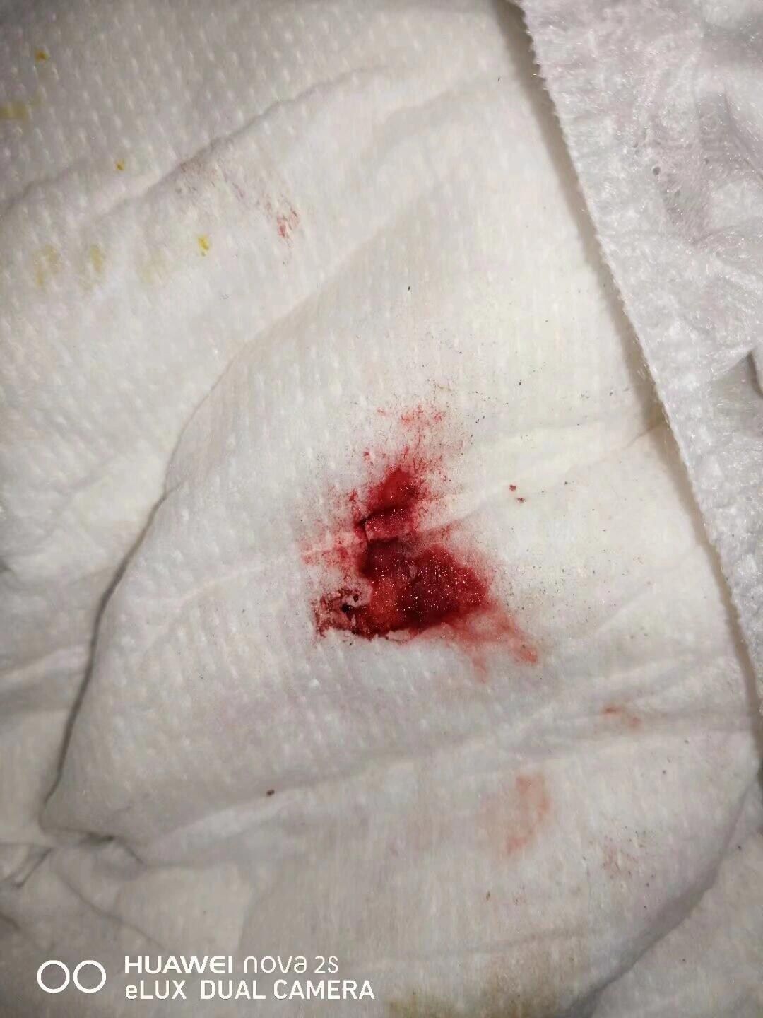 月经来完10天又出血