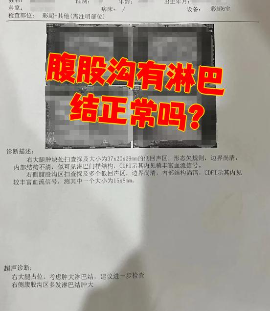 淋巴结核传染吗