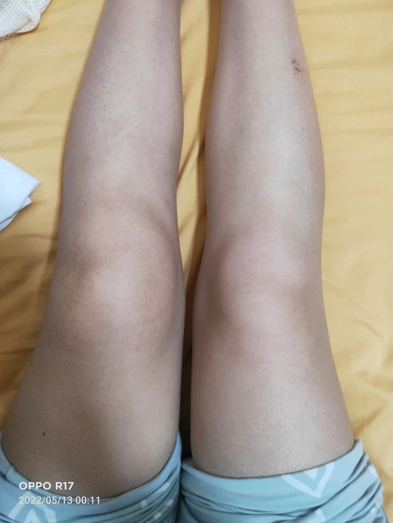 滑膜炎的症状有什么