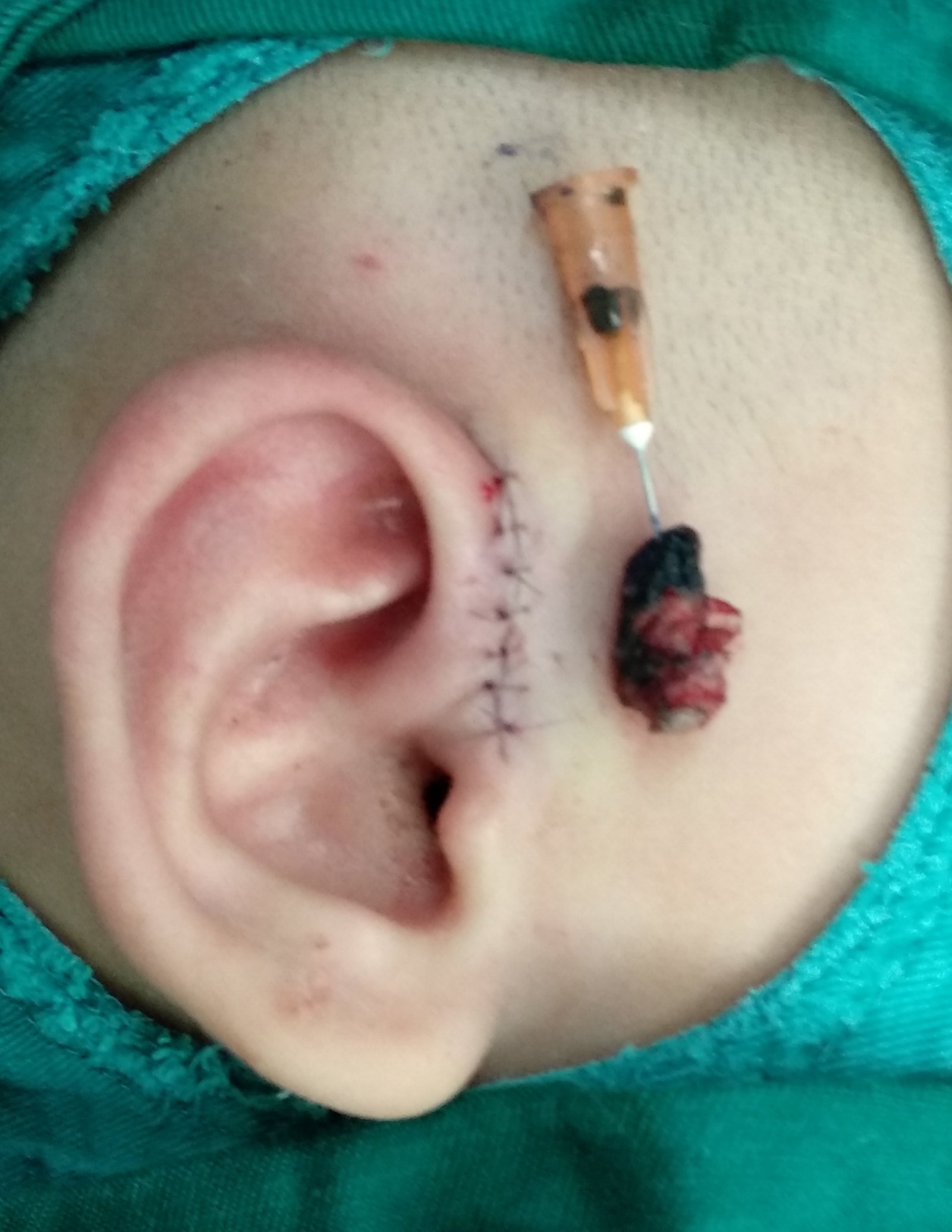 耳前瘘管切除手术