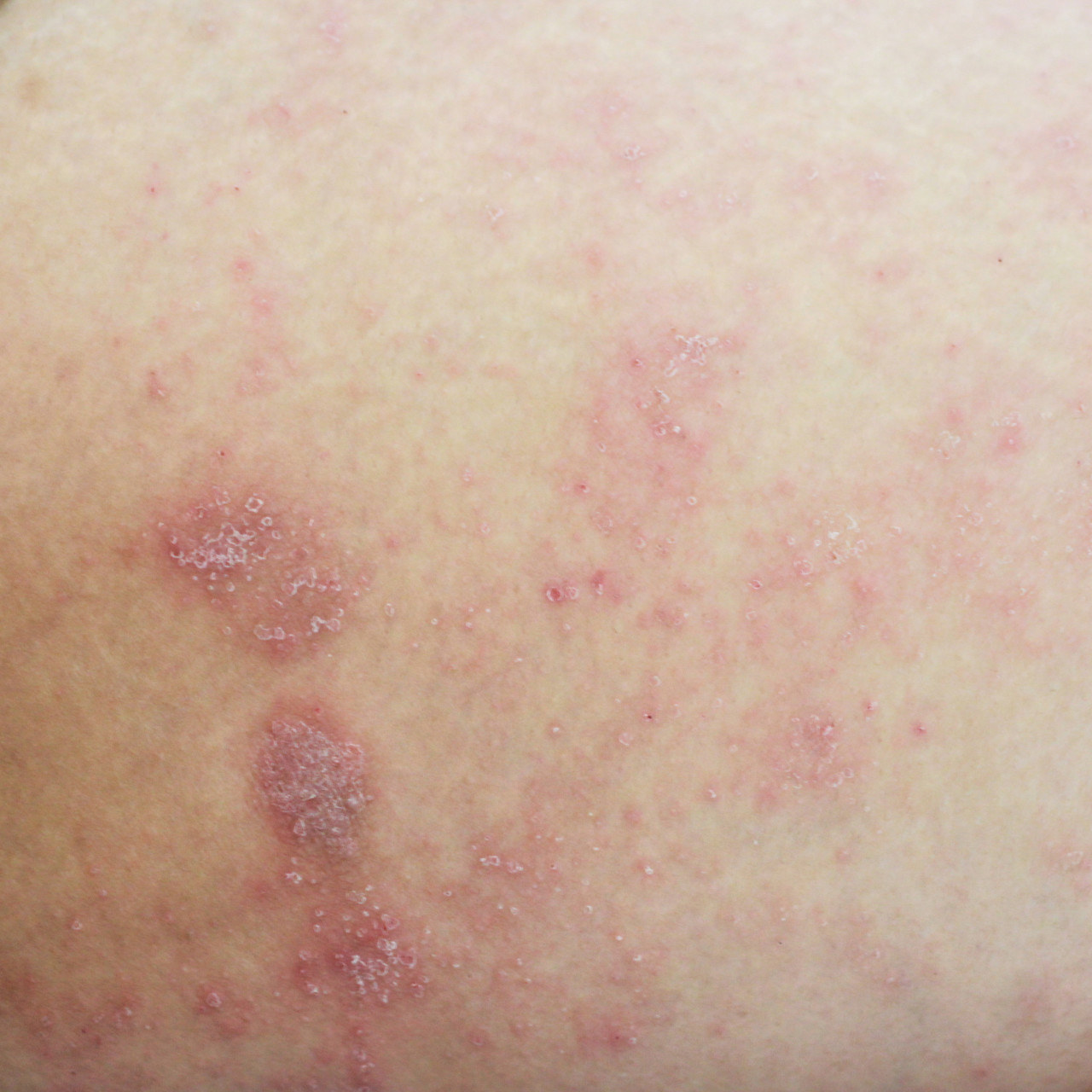 皮肤长小疙瘩很痒