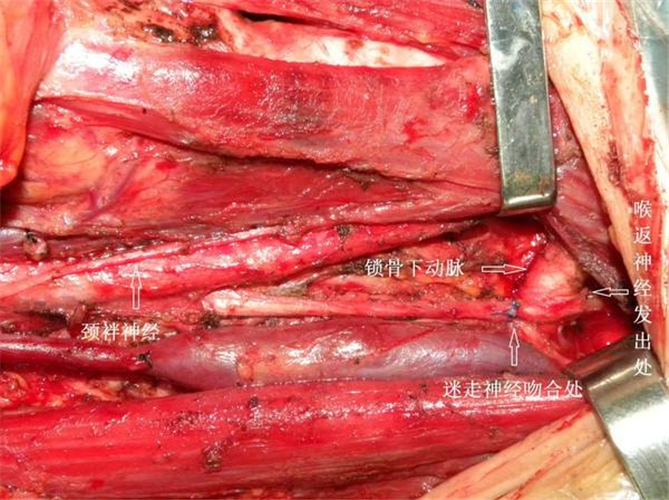 晚期甲状腺癌能活多久