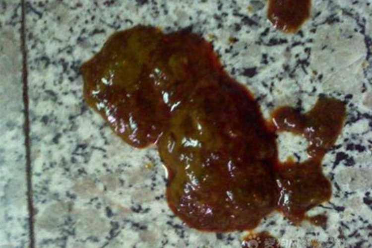 大便出血鲜红不痛