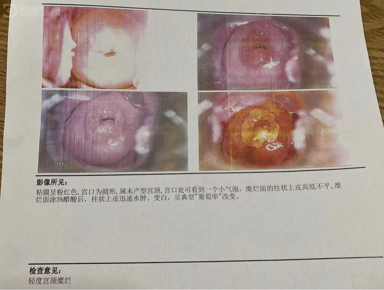 宫颈糜烂是病吗