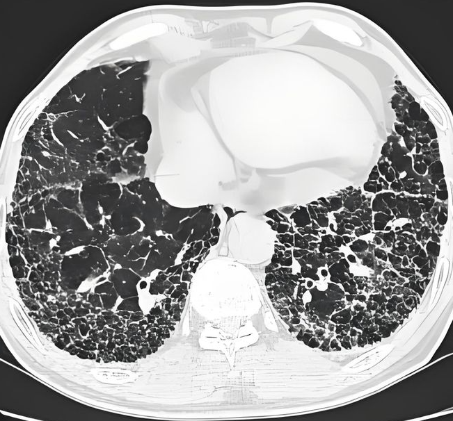 肺间质纤维化严重吗