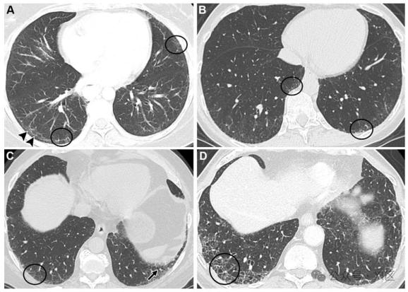 肺间质纤维化严重吗
