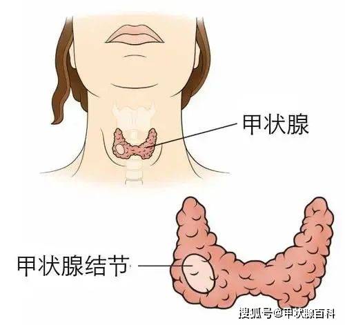 甲状腺癌严重吗