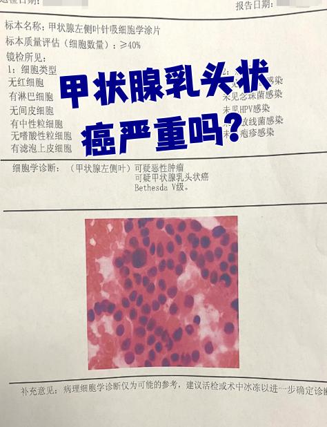 甲状腺癌严重吗