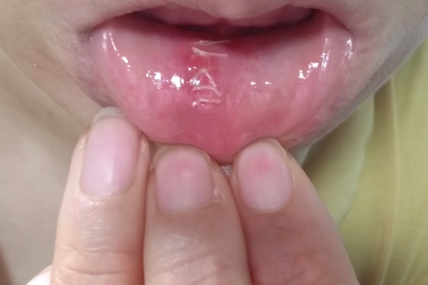 婴儿肺炎的早期症状有哪些