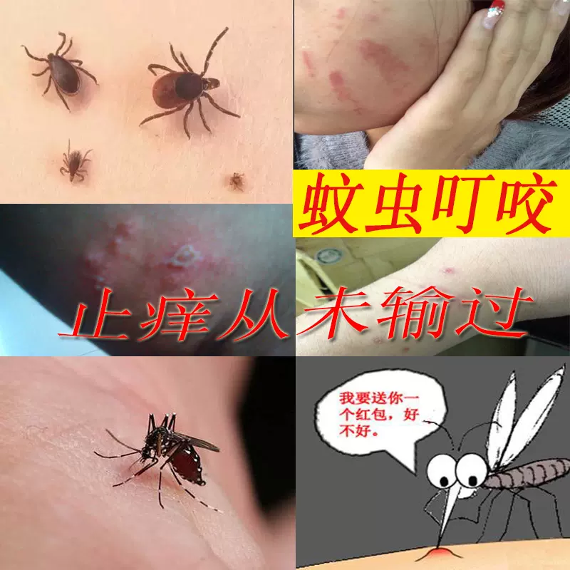 被臭虫咬了擦什么药