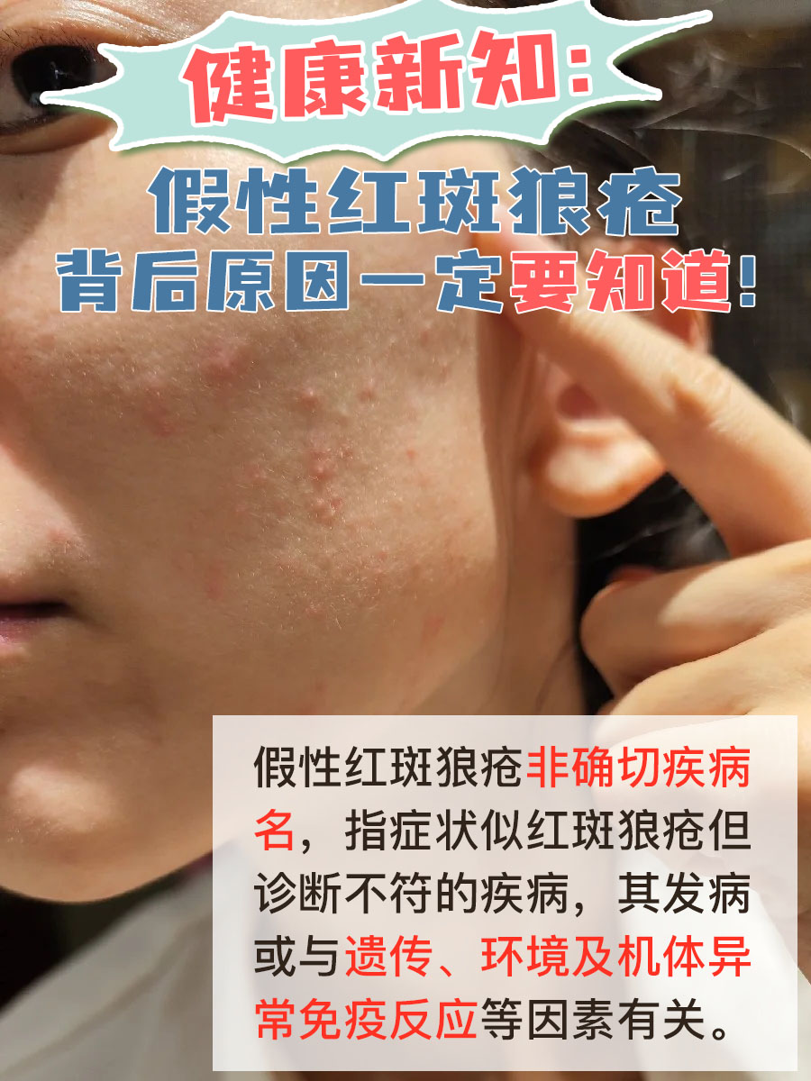 系统性红斑狼疮发病率