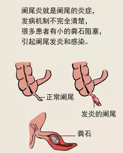 阑尾在哪个位置?