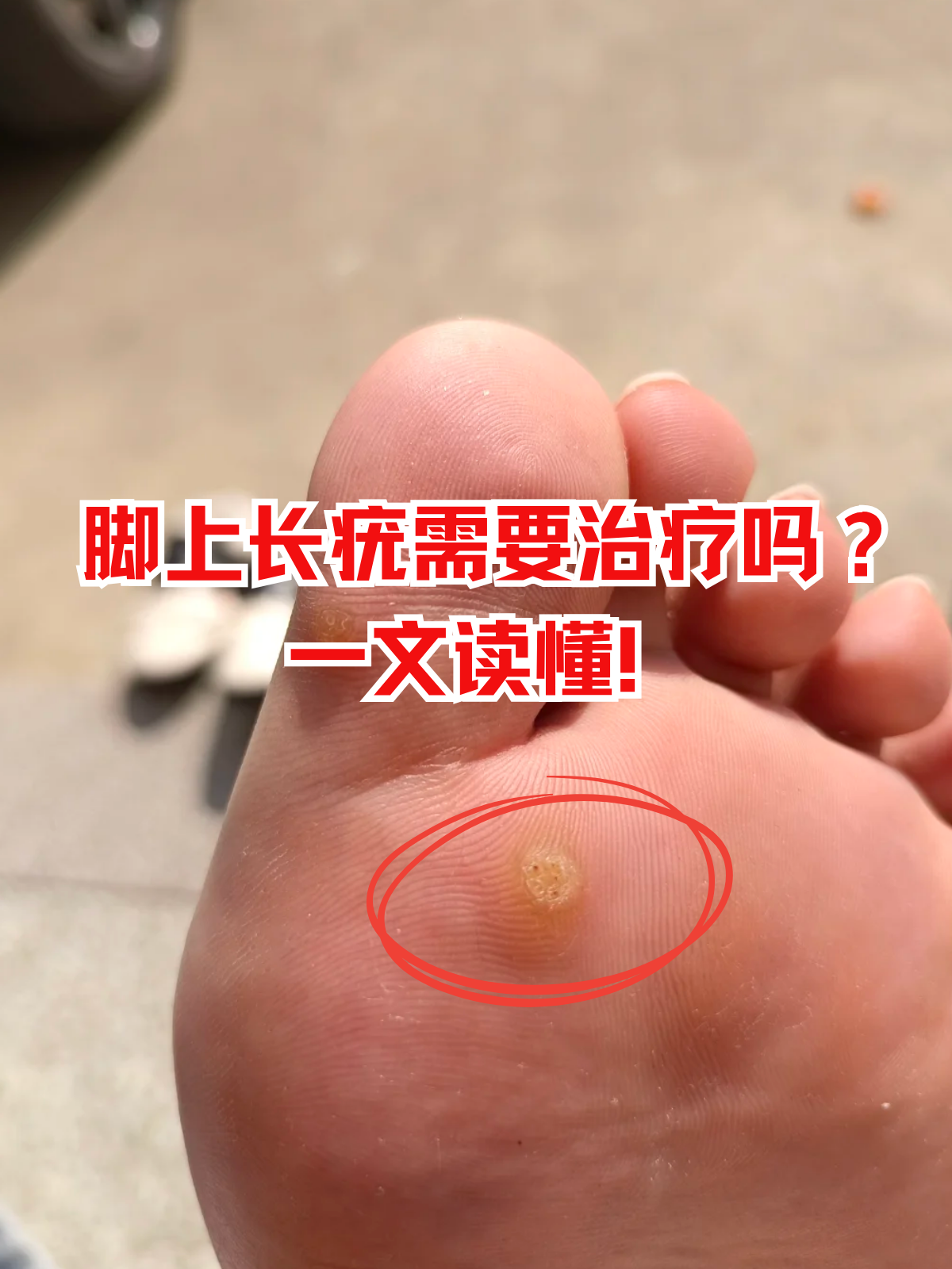 脚上起茧子怎么消除