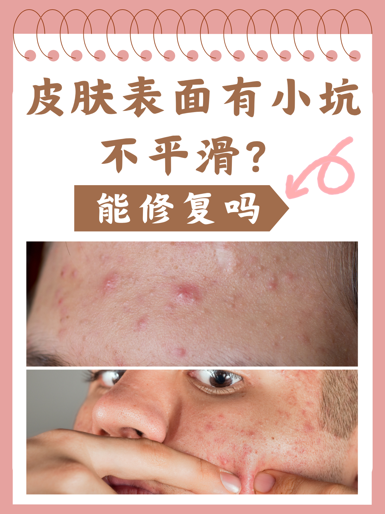 痘痘留下的坑怎么办