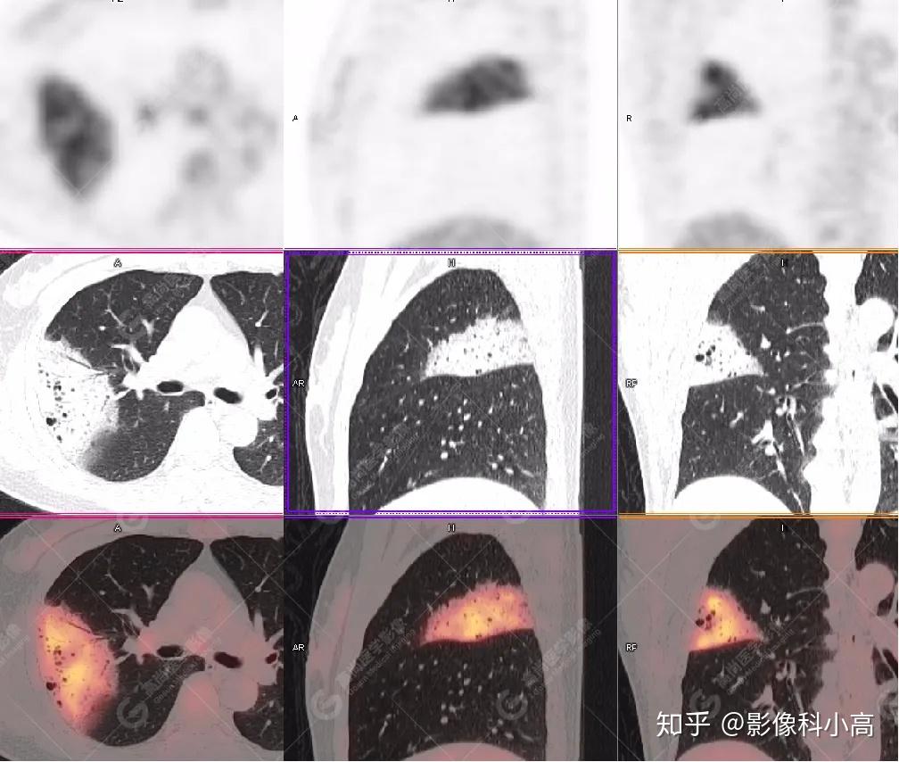 NSE稍微偏高是什么原因