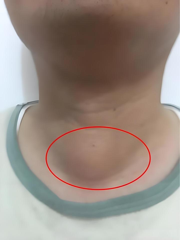 甲状腺肿大的症状有哪些?