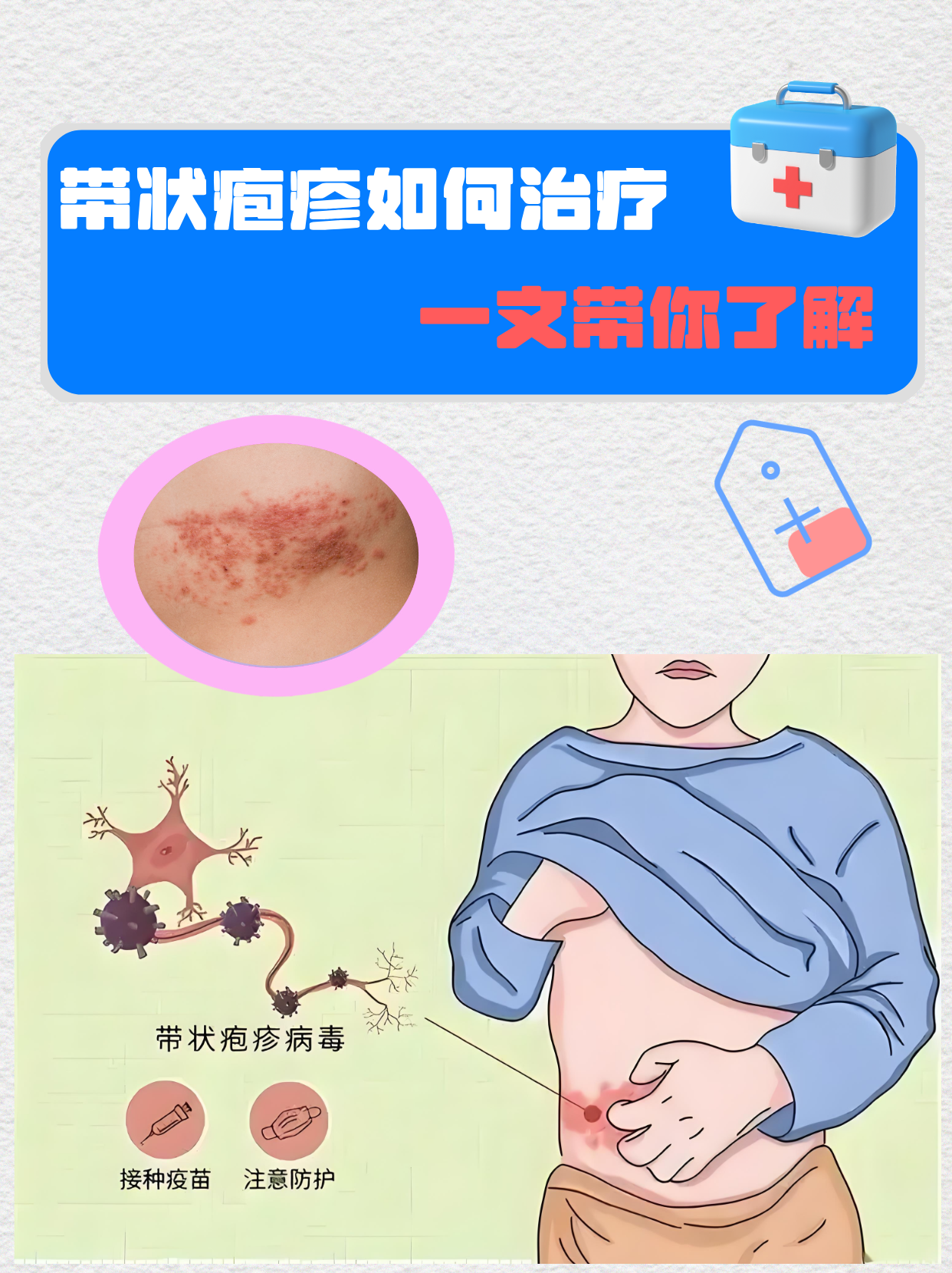 蛇胆疮怎么治疗?多久能好