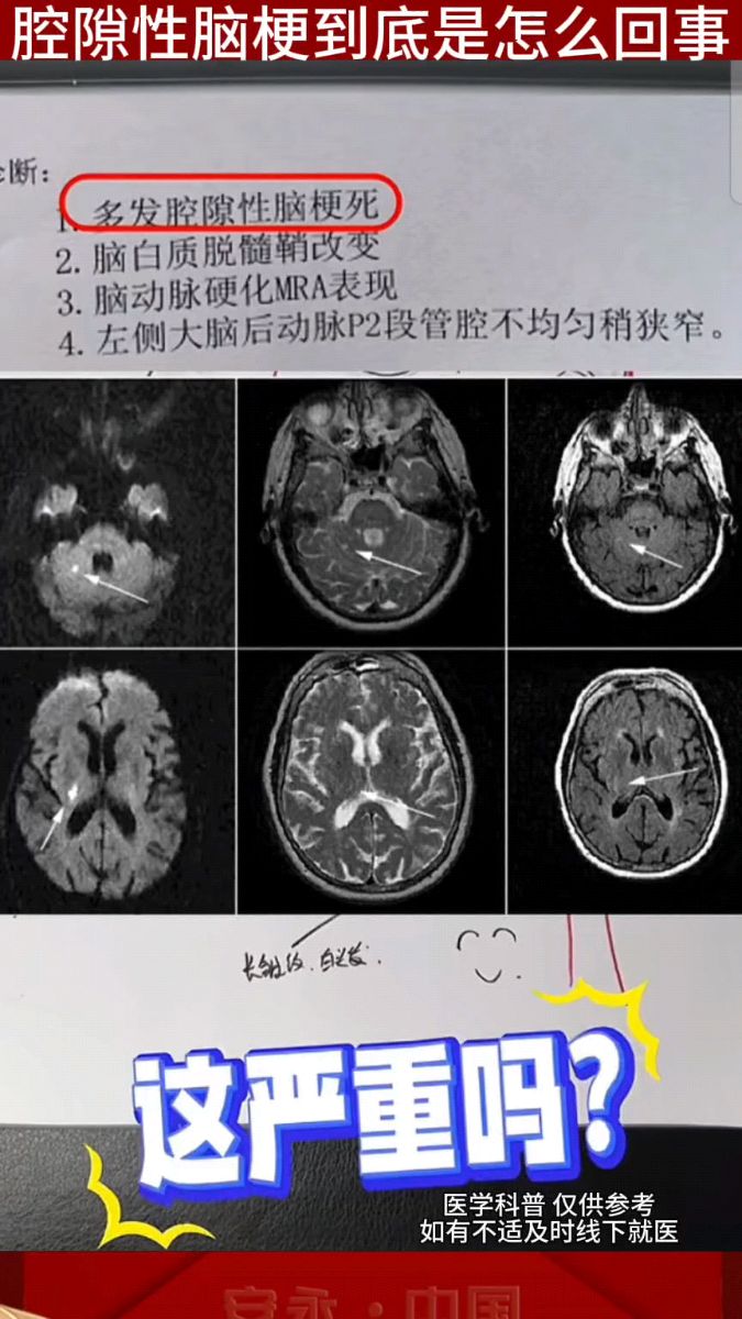 腔隙性脑梗塞是什么