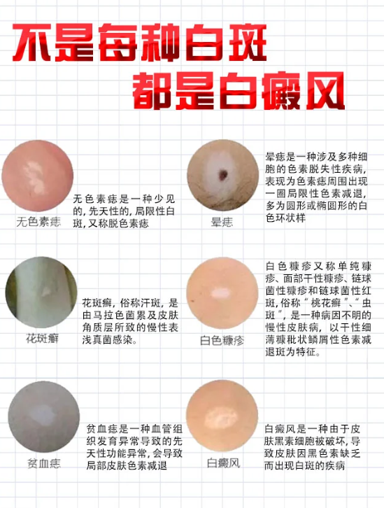 白色糠疹白斑怎么办