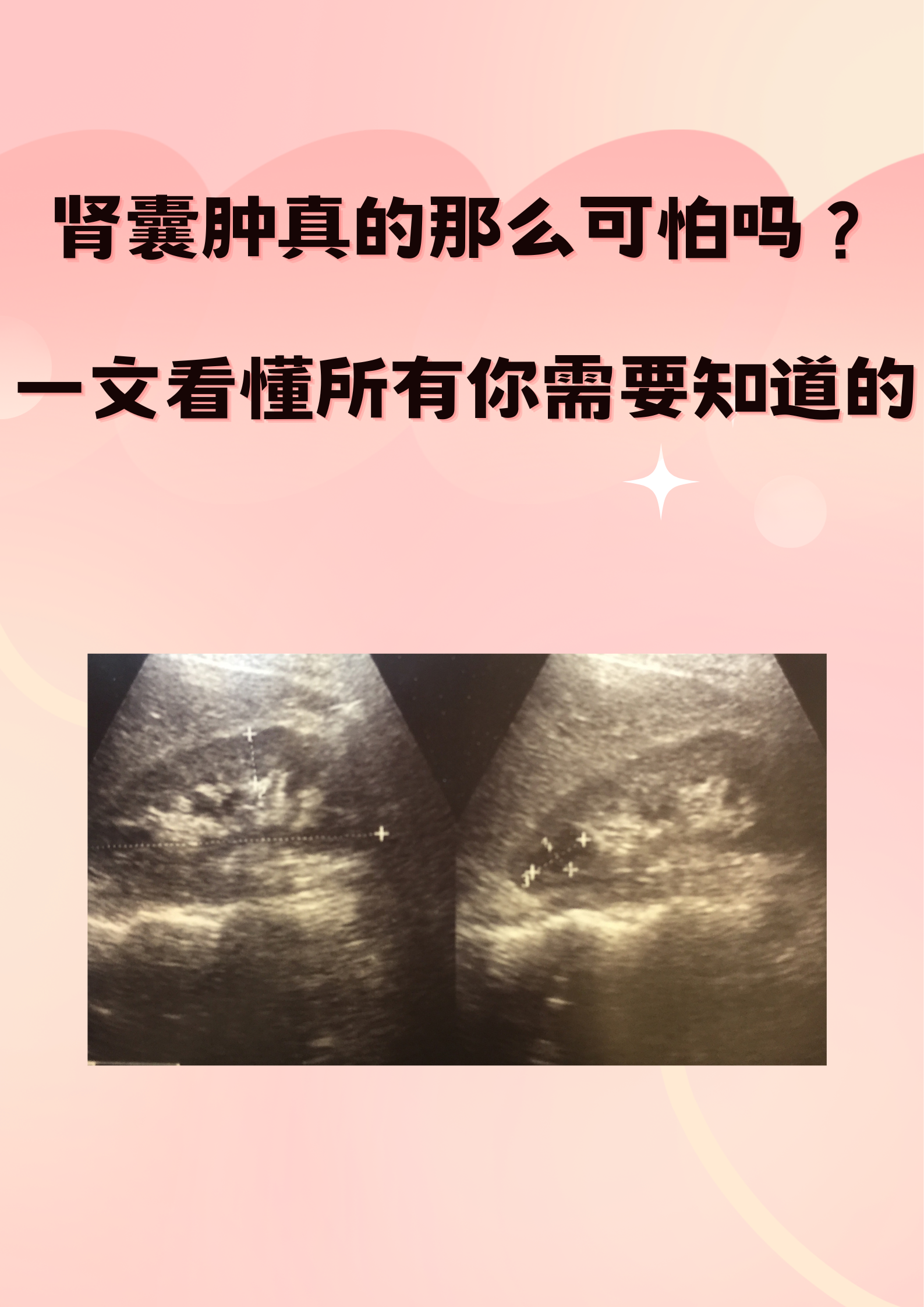 肾囊肿的危害有哪些