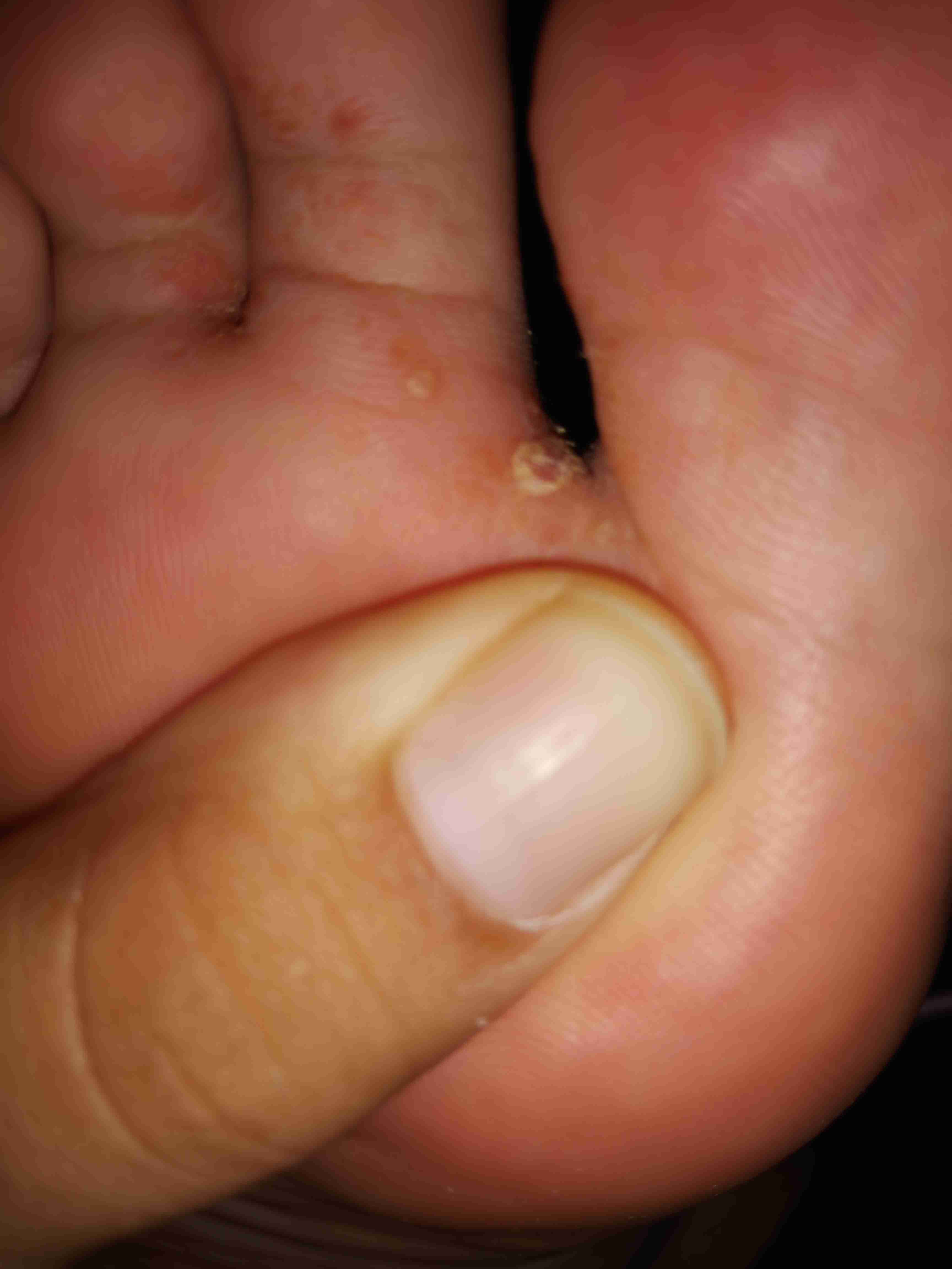 脚趾缝里长了个硬疙瘩