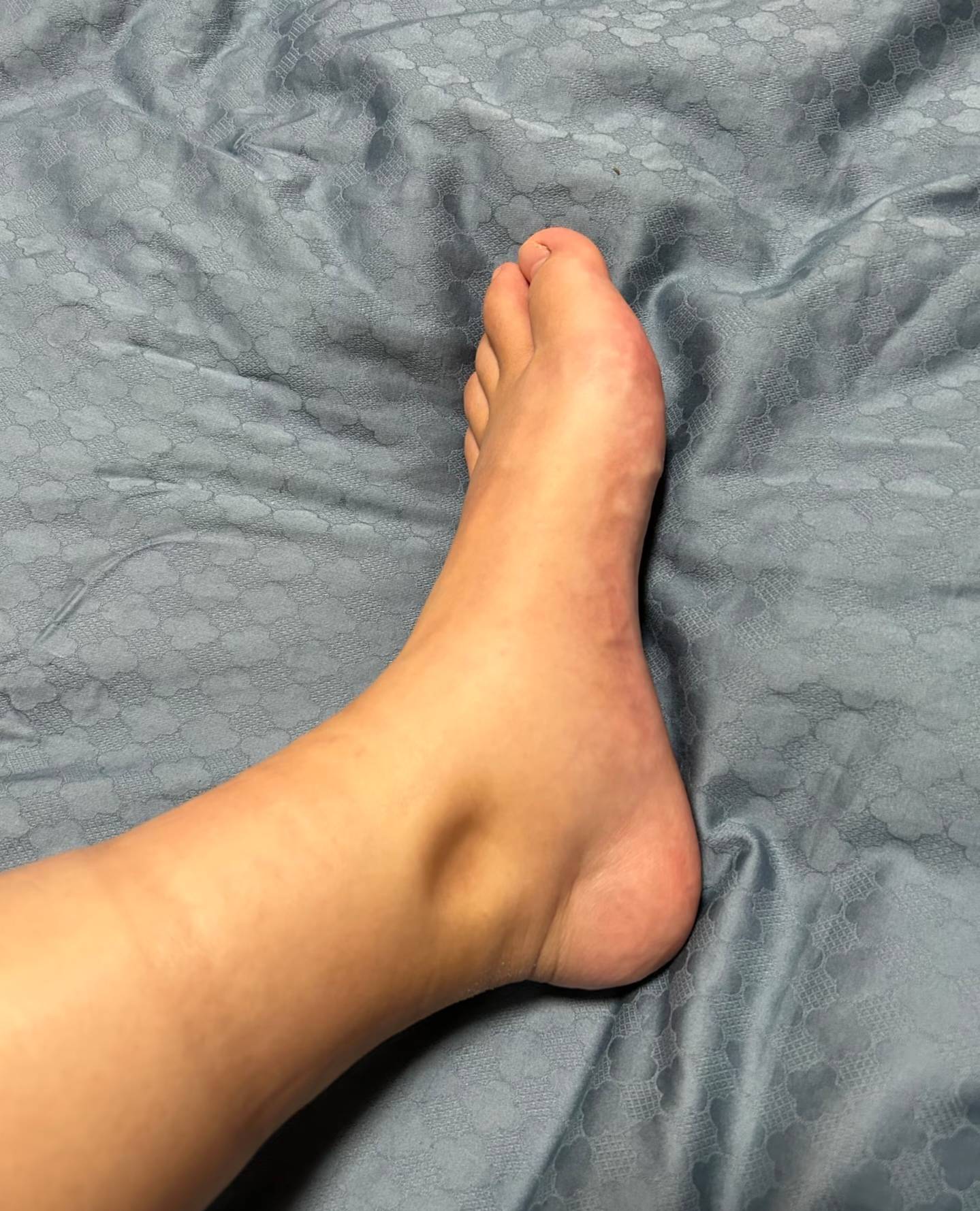 甲减症状的表现