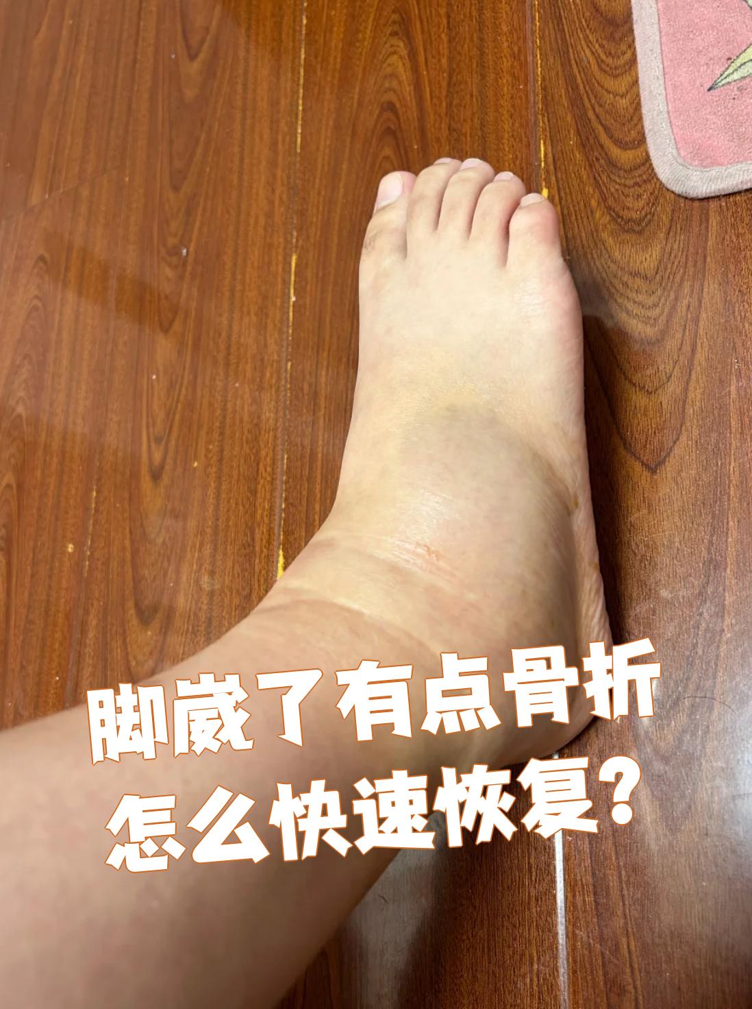 脚崴了能走路算骨折吗