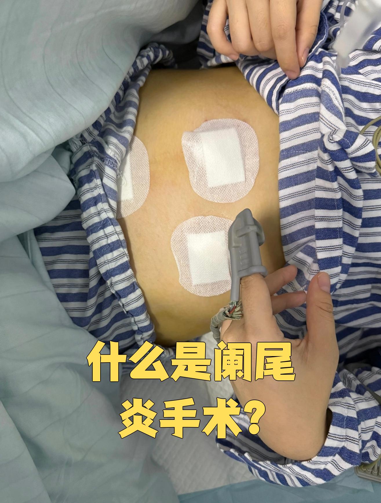 急性阑尾炎要做手术吗