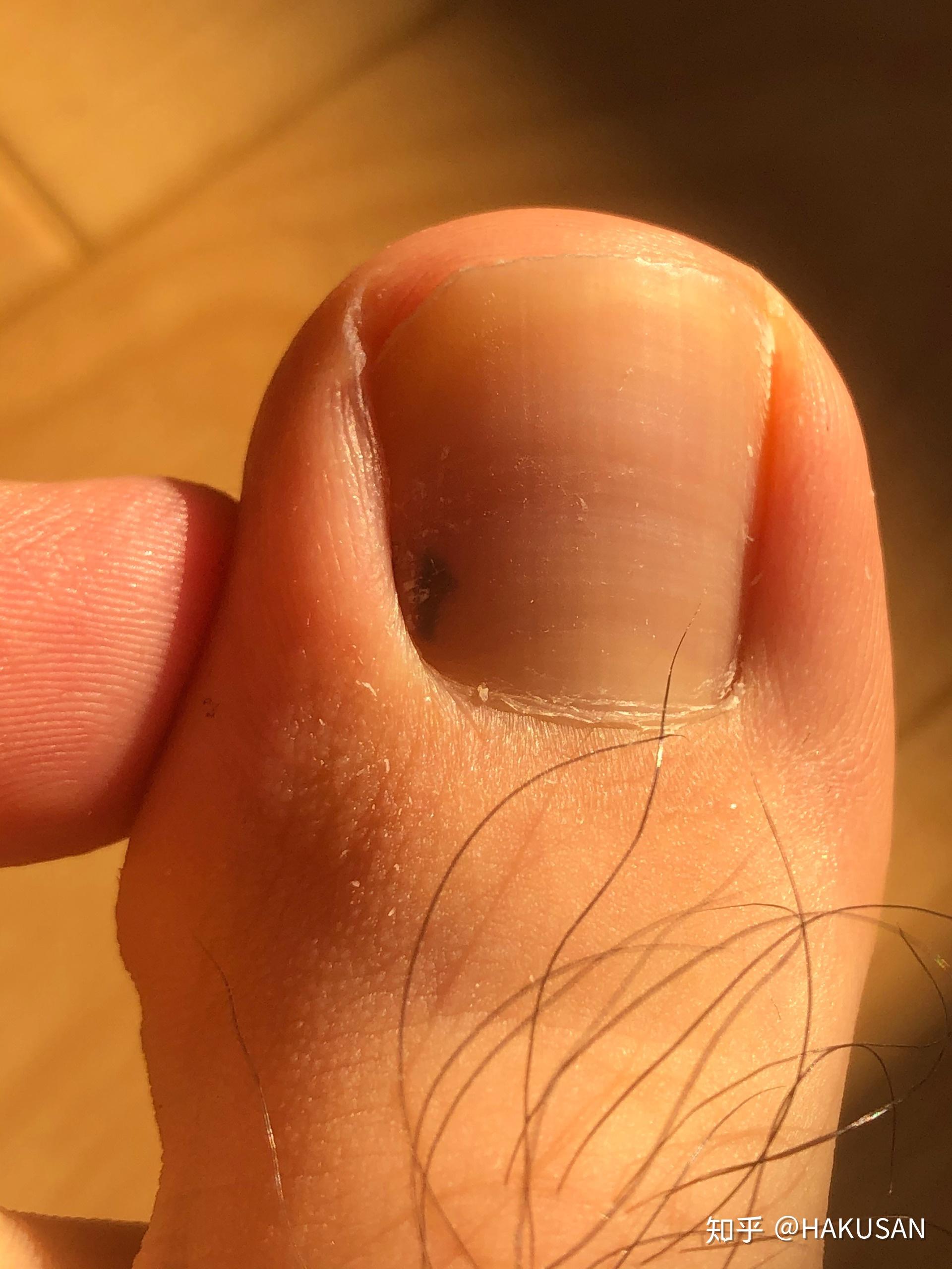 脚趾甲里有黑点