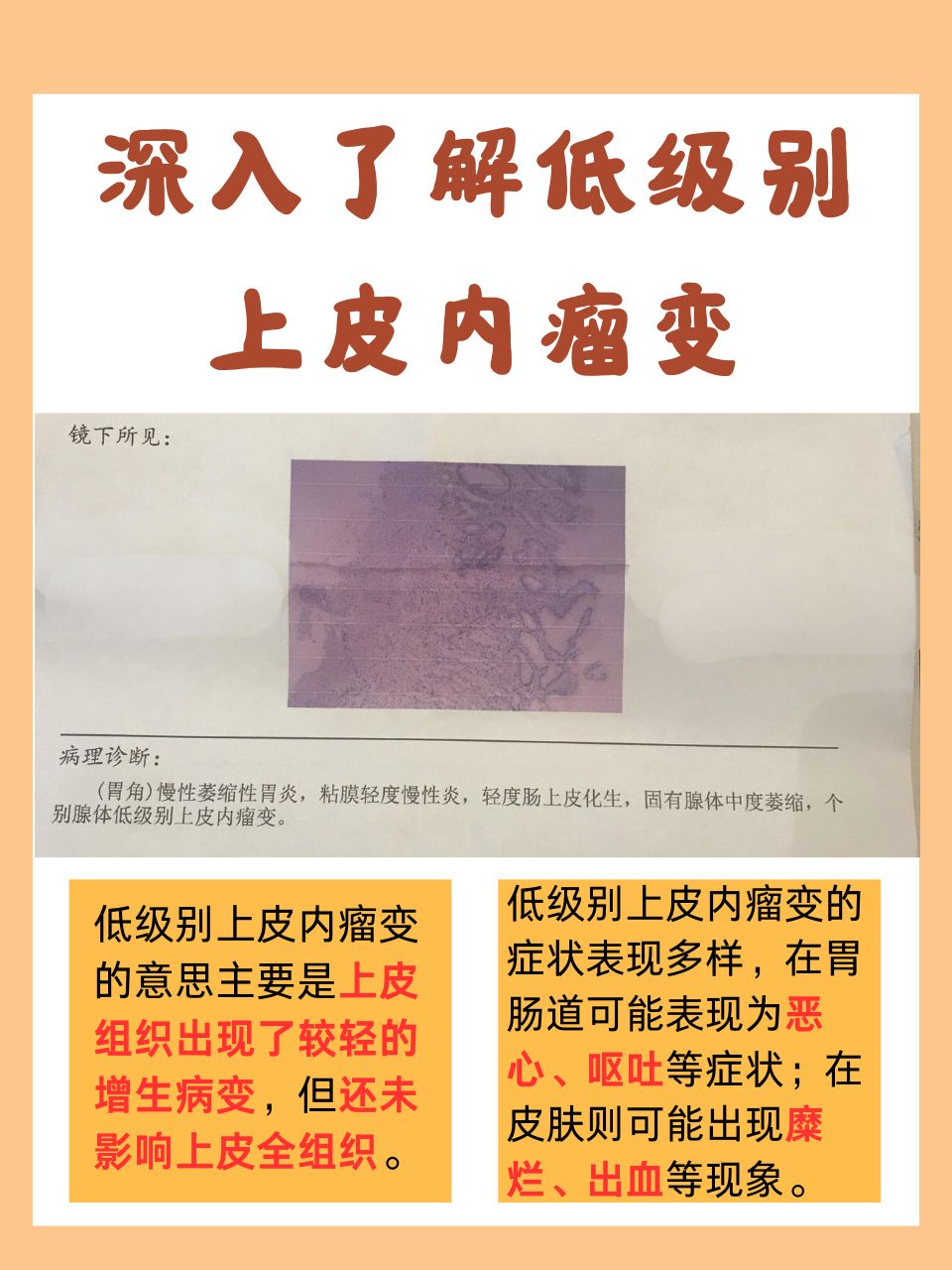 鳞状上皮内高度病变是癌吗