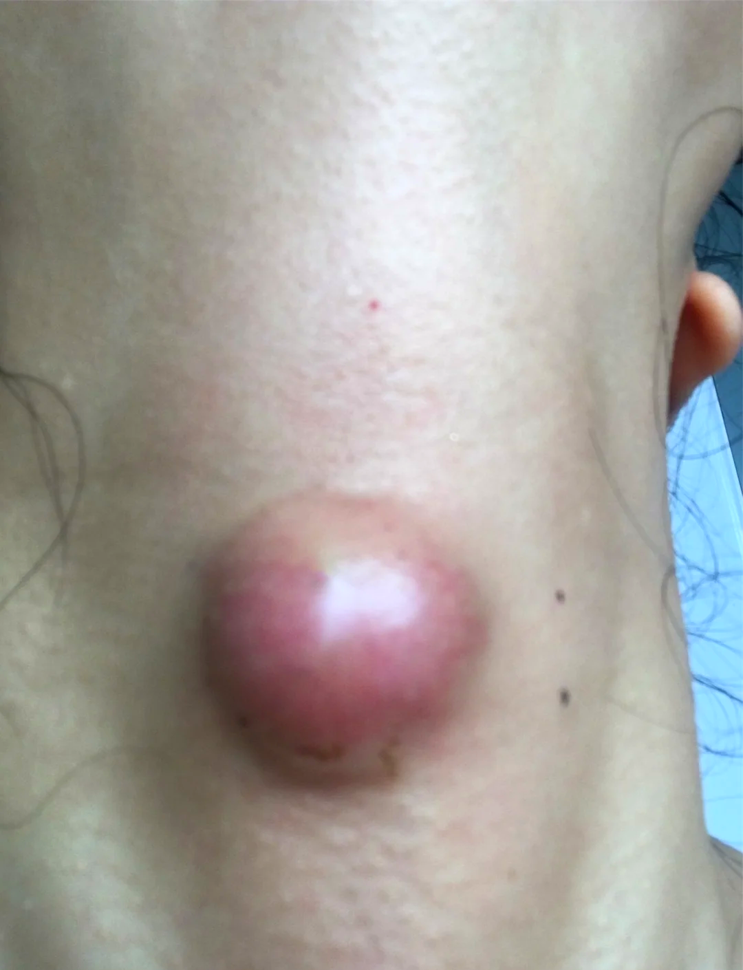 巴氏腺囊肿很严重吗