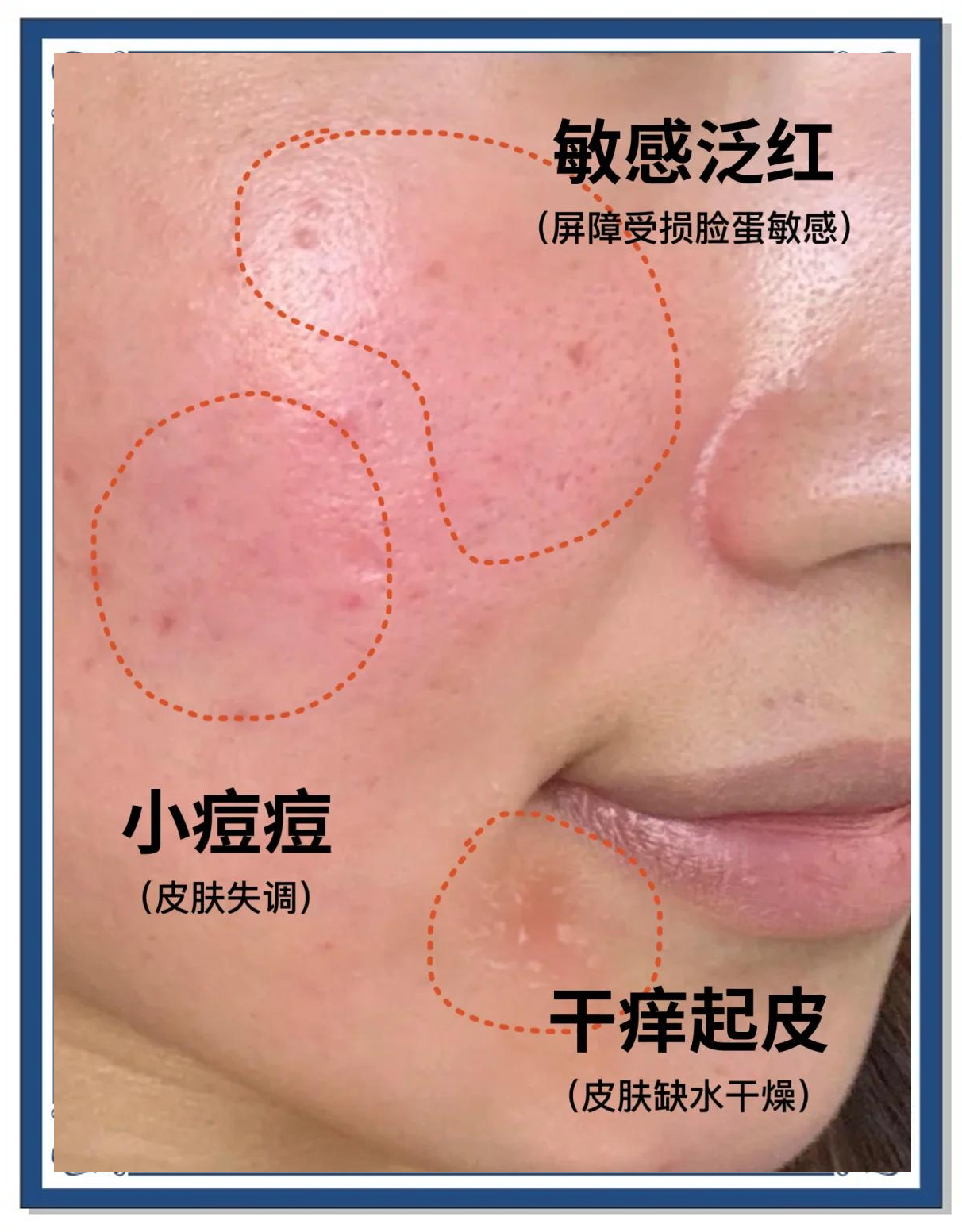 面部过敏性皮炎怎么治