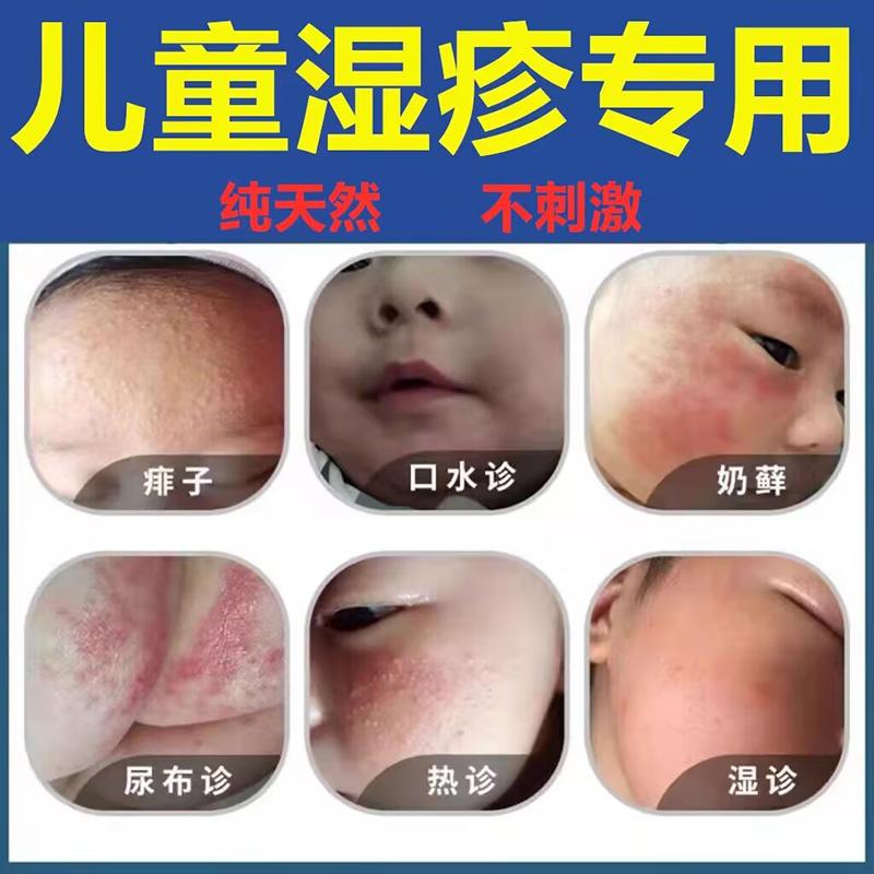 宝宝长奶藓怎么办?