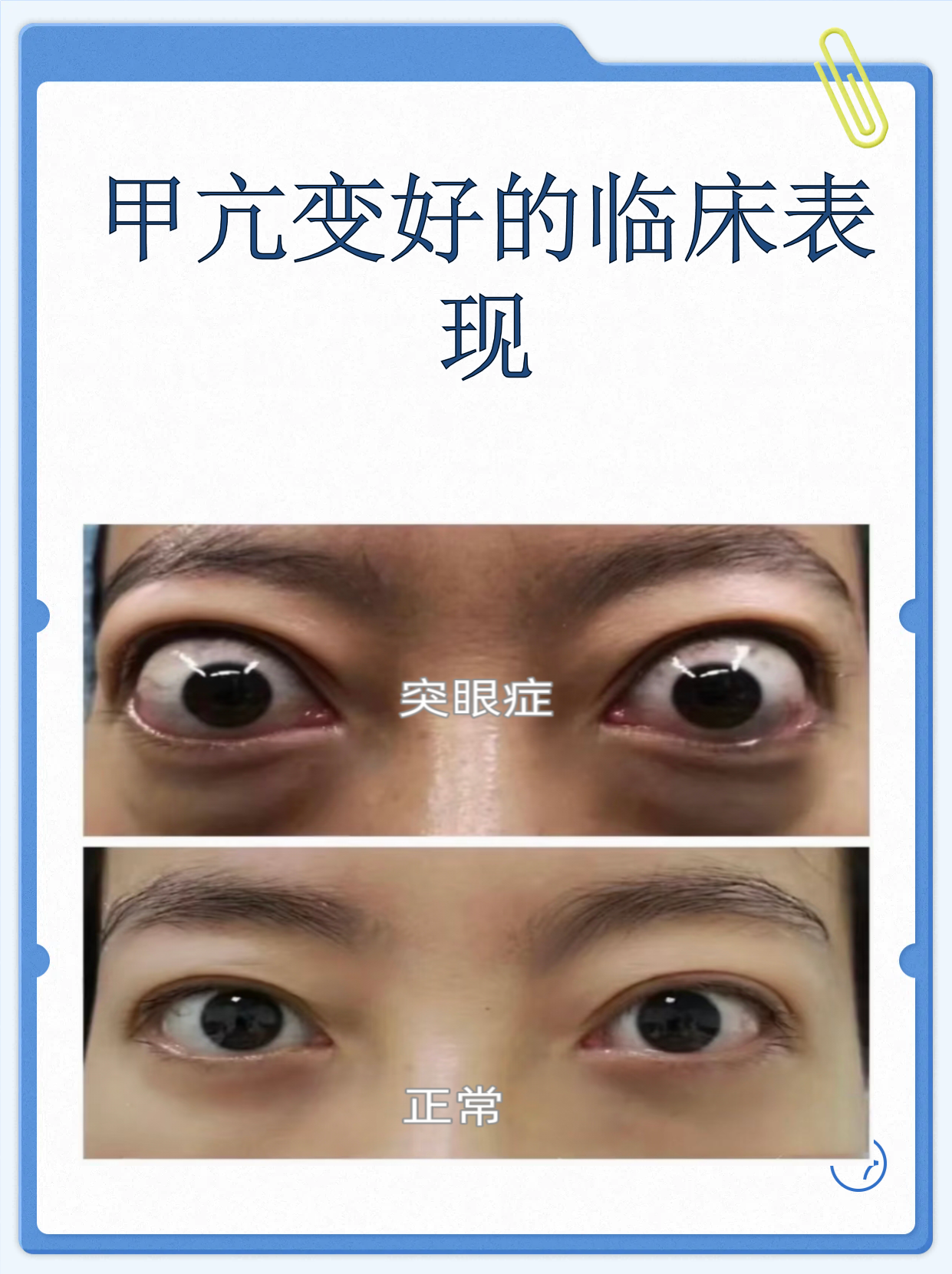 甲状腺功能亢进症初期有什么症状