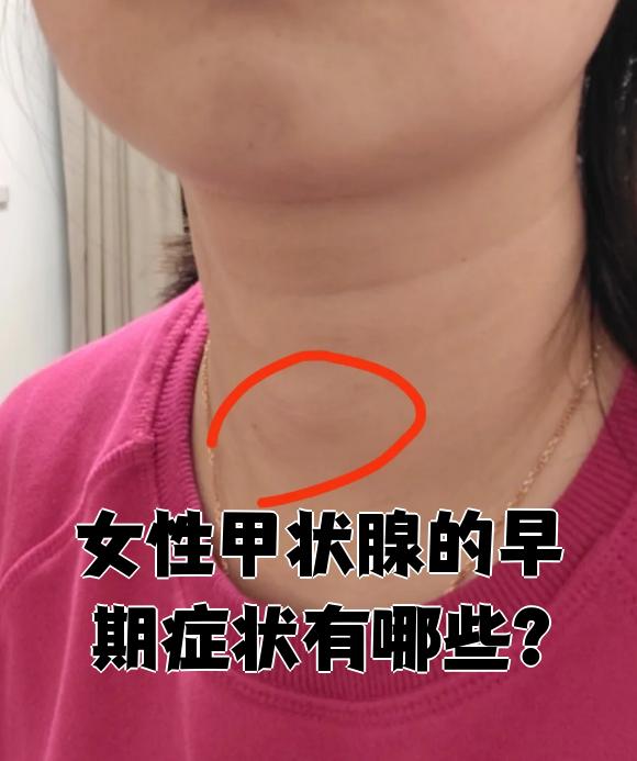 甲状腺功能亢进症初期有什么症状