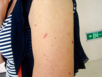 白血病早期症状