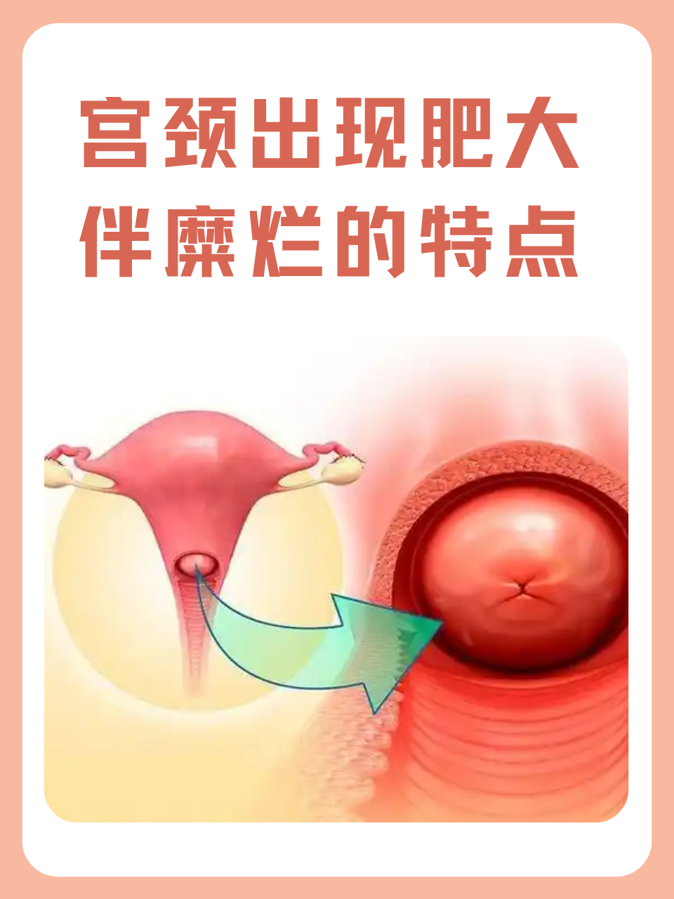 有宫颈肥大怎么办