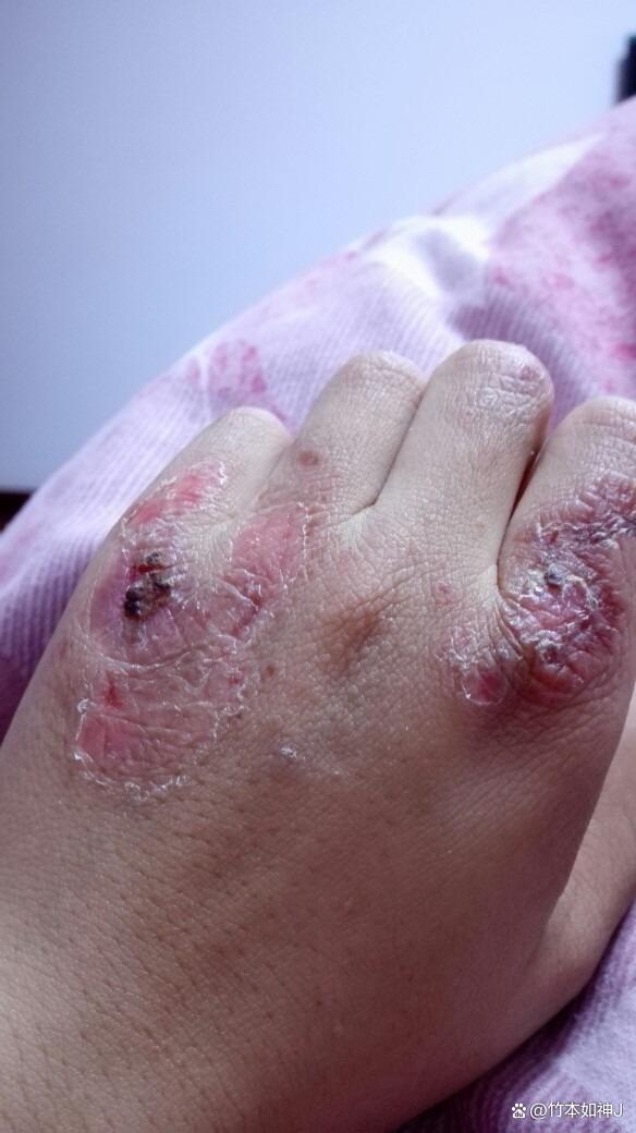 手冻肿了很痒怎么办