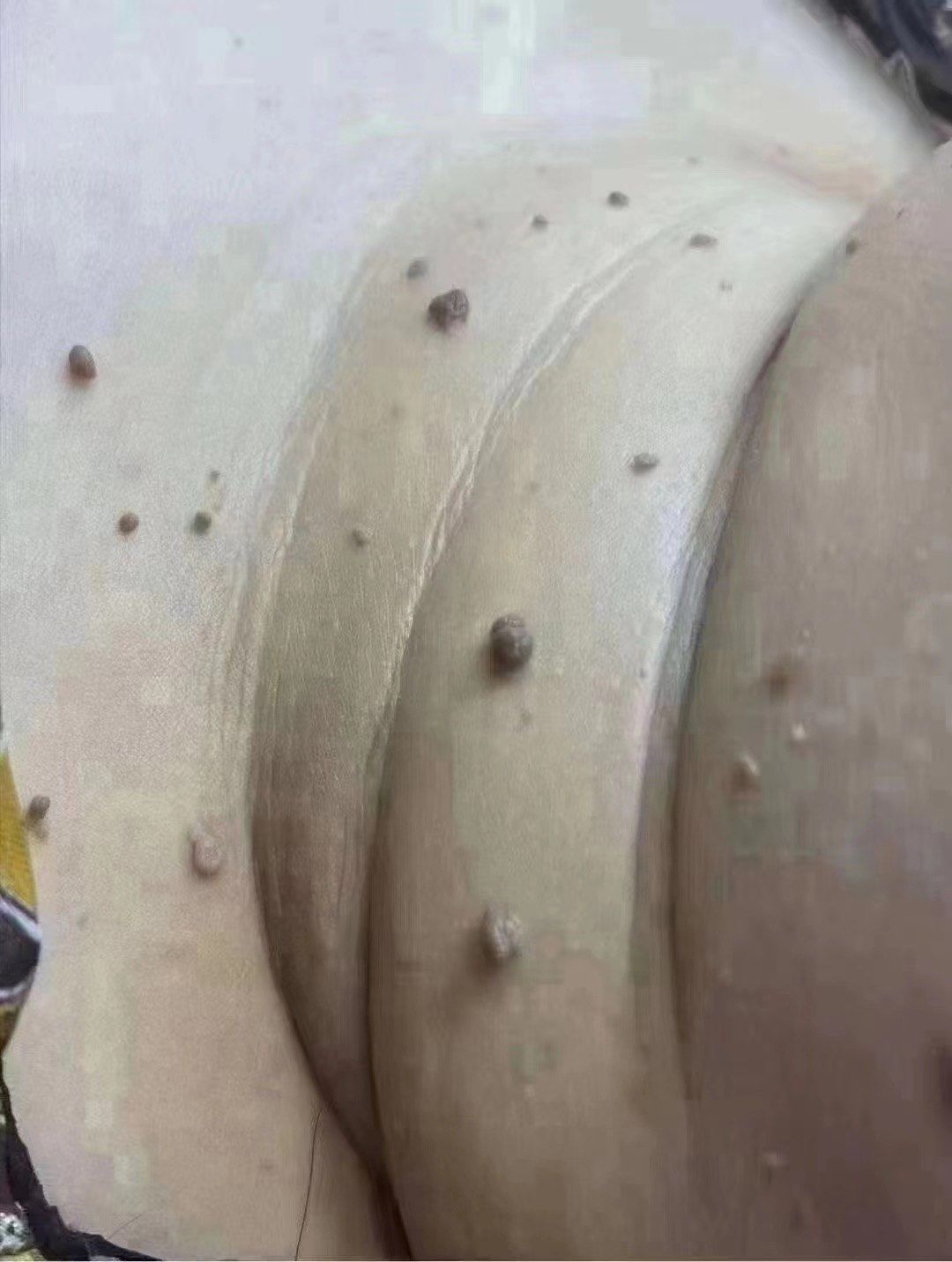 脖子上长小肉疙瘩