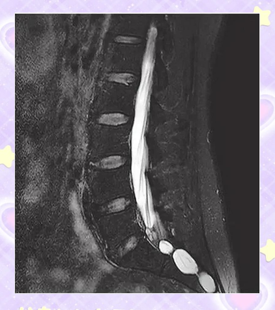 骶管囊肿如何治疗?